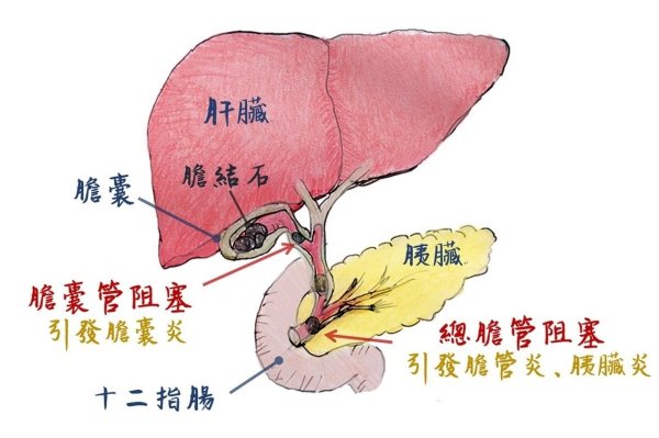 Man has had intermittent eating, but he has acute cystitis